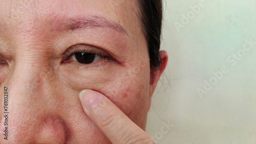 portrait showing the fingers holding the flabbiness and wrinkle under the eye, swelling and loose, dark spots and blemish, freckles and ages on the face of the woman, health care and beauty concept.