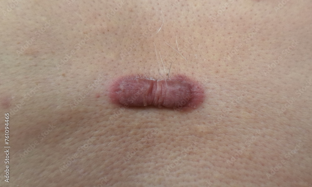 Fototapeta premium Keloid scars are large, raised scars.