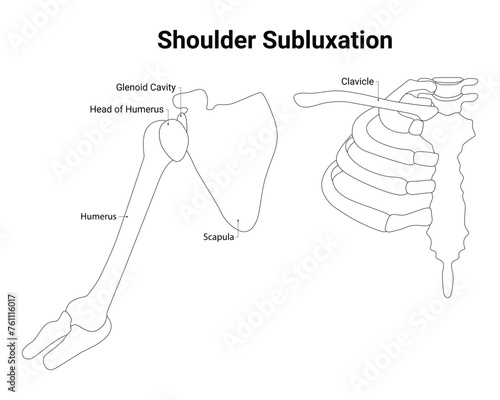 Shoulder Subluxation Science Design Vector Illustration Diagram