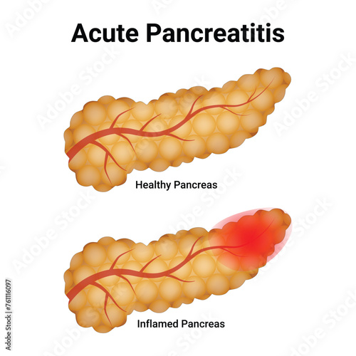 Acute Pancreatitis Science Design Vector Illustration Diagram