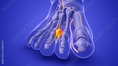 A Morton's neuroma on a foot nerve