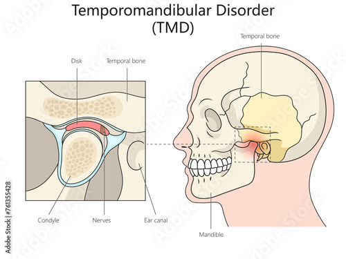 Human Temporomandibular disorder diagram hand drawn schematic raster illustration. Medical science educational illustration