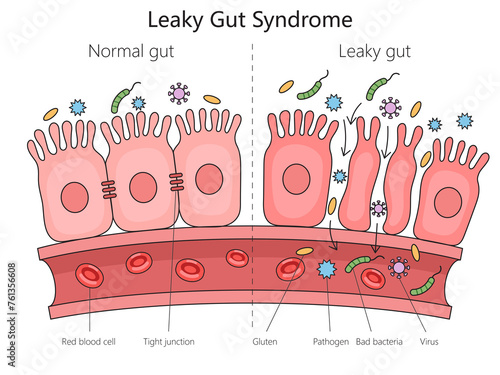 normal gut and leaky gut syndrome with labeled elements like bacteria and tight junctions structure diagram hand drawn schematic raster illustration. Medical science educational illustration photo