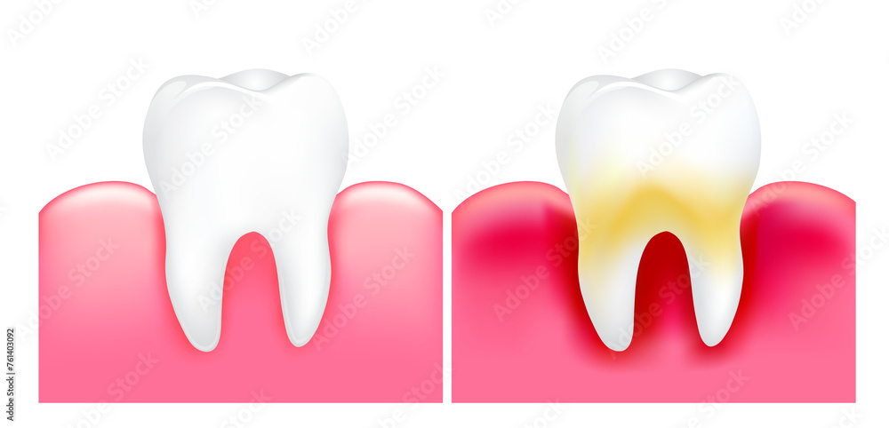 Dental plaque with inflammation and healthy tooth. Illustration. Dental care concept. Dental plaque with inflammation and healthy tooth. Illustration. Dental care concept.