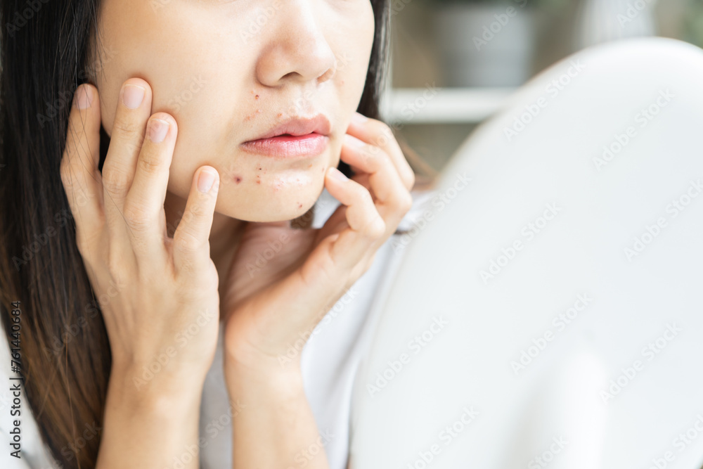 Expression worry asian young woman looking at mirror touching pustule around the chin and mouth, allergic when wear mask, spot scar from pimple on face. Beauty care, skin problem by acne treatment. Expression worry asian young woman looking at mirror touching pustule around the chin and mouth, allergic when wear mask, spot scar from pimple on face. Beauty care, skin problem by acne treatment.