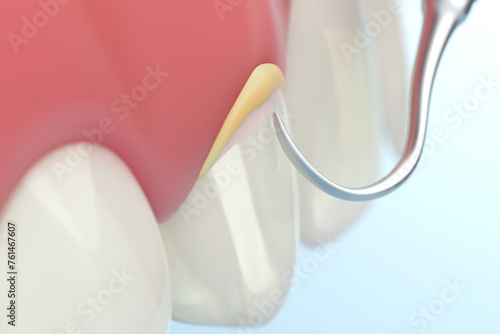 Photos tartar removal tool removing dental calculus sticking on teeth and gums