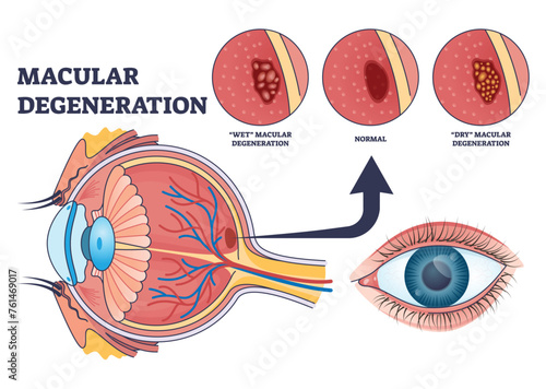 Macular degeneration as eye illness and eyesight problem outline diagram. Labeled educational scheme with central vision loss disease with wet or dry types vector illustration. Medical retina health.