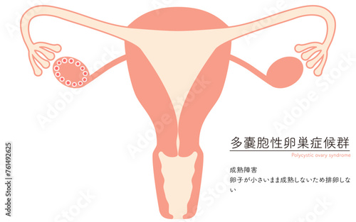 多嚢胞性卵巣症候群（成熟障害）の図解イラスト、子宮・卵巣の解剖図