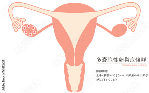 多嚢胞性卵巣症候群（排卵障害）の図解イラスト、子宮・卵巣の解剖図