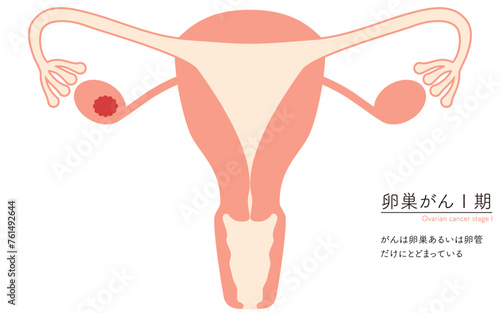 卵巣がんI期の図解イラスト、子宮・卵巣の解剖図