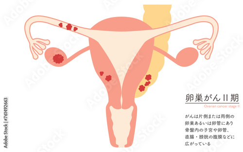 卵巣がんII期の図解イラスト、子宮・卵巣の解剖図 photo