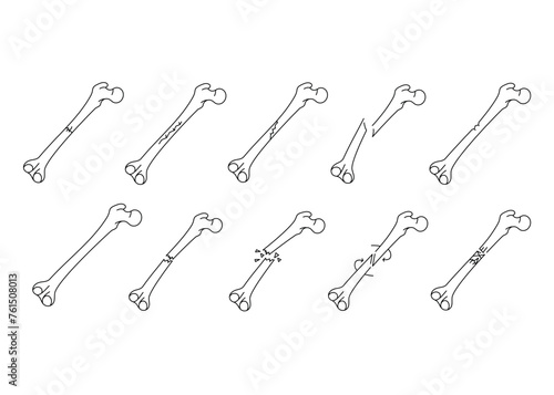 Bone fracture line icons set. Vector isolated element.