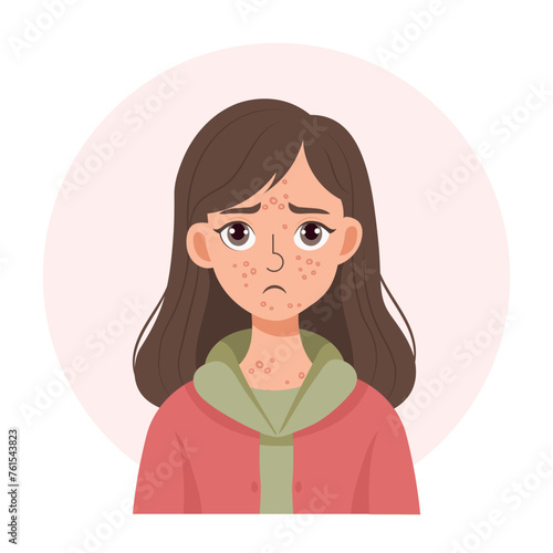 Acne. Unhappy teenage girl with acne and pimples on her face. Irritated facial skin. Illustration, vector