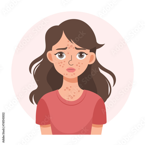 Acne. Unhappy teenage girl with acne and pimples on her face. Irritated facial skin. Illustration, vector