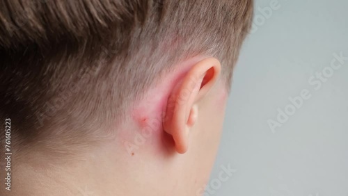Concept of allergic reaction by mosquito bites. Ear close-up. Head of child with irritated swollen skin from insect bite. Body care. A strong itch photo