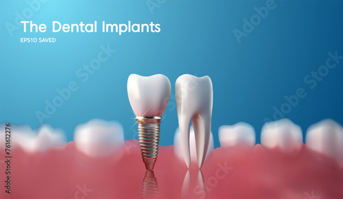 White tooth implant implant cut, healthy tooth or dental surgery. vector illstration.