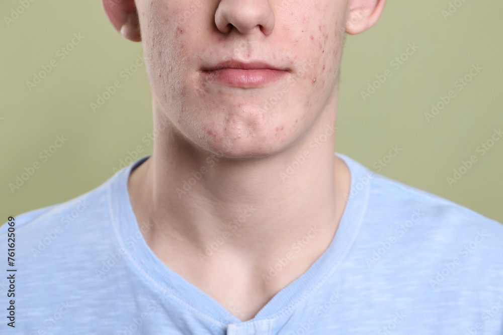 Fototapeta premium Young man with acne problem on olive background, closeup