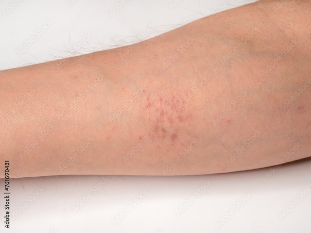 Red rash - skin reactions on the skin on male forearm.