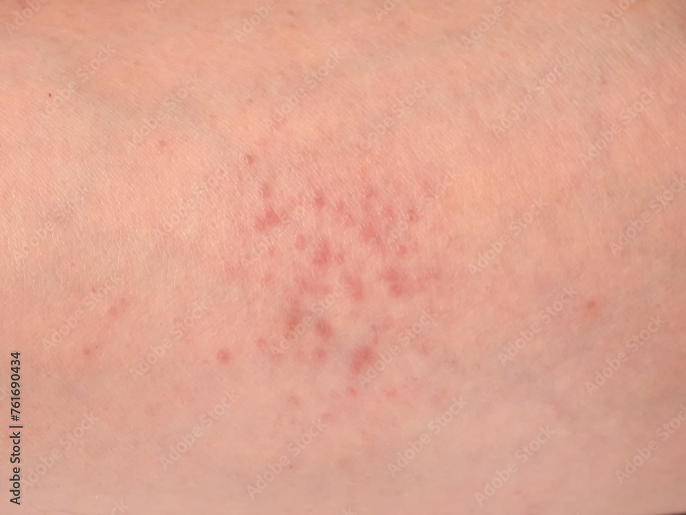Fototapeta premium skin reactions on the skin on male forearm