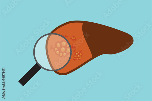 Liver cancer, oncology and medicine, liver tumor vector icon, vector graphics