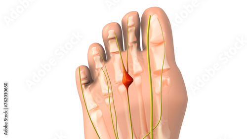 Pinched nerve or neuroma medical animation photo