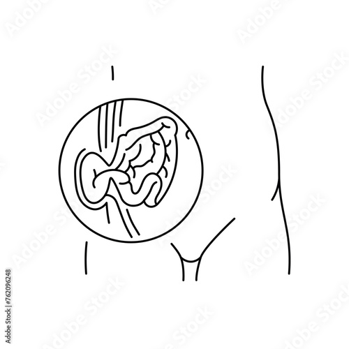 Strangulated hernia line icon. Vector isolated element.