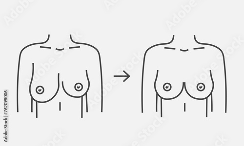 Asymmetric breast correction before and after. Female breast plastic surgery front view. Line con set. Vector illustration 