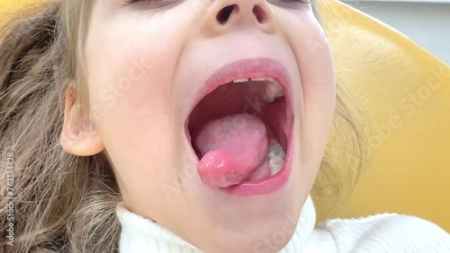 Close-up of little girl opening her mouth wide to the doctor to show her throat. Child is sitting with wide open mouth, with a tongue stuck out, clear view on the uvula and the soft palate