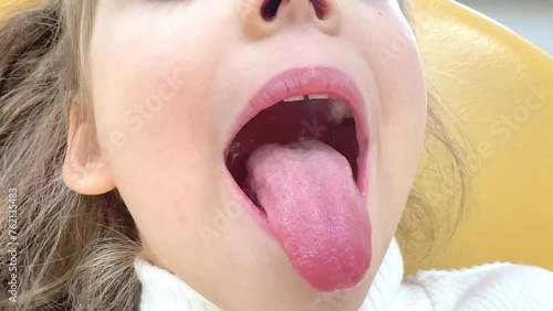 Close-up of little girl opening her mouth wide to the doctor to show her throat. Child is sitting with wide open mouth, with a tongue stuck out, clear view on the uvula and the soft palate