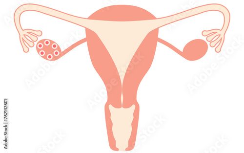 Diagrammatic illustration of polycystic ovary syndrome (ovulation disorder), anatomy of the uterus and ovaries