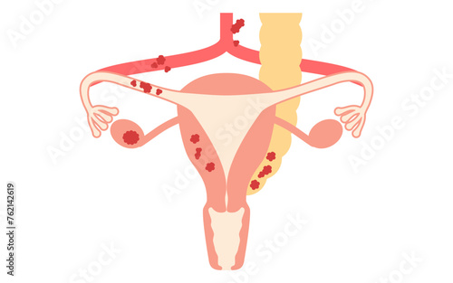 Diagrammatic illustration of stage III ovarian cancer, anatomy of the uterus and ovaries