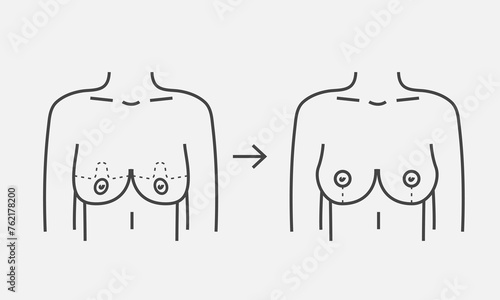 Correction female breast line icon. Plastic surgery procedure. Vector illustration