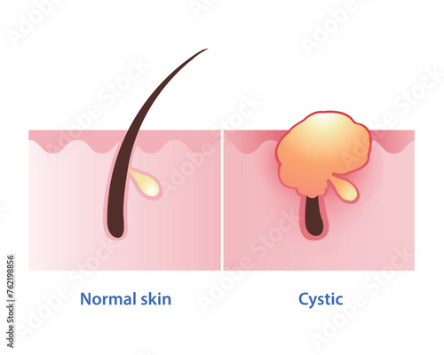 Cystic acne, the most severe type of inflammatory acne vector on white background. Normal skin and cyst develop pus filled pimple deep under the skin, often painful, large and to cause scarring.