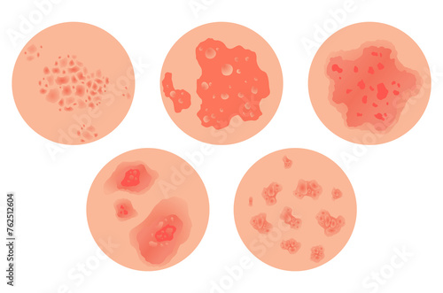 Different types of psoriasis set. Part of patients skin with dermatitis, inflammation, red rash and other skin problems. Cartoon illustration for disease concept
