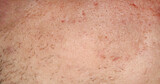 Texture of porous skin with traces of pimples and acne. Problem skin treatment concept. High quality stock photo.