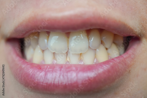 Close up photo of a woman's teeth containing tartar dental plaque