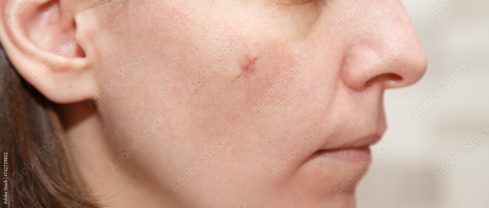 Real scar on the young woman face, scar on the cheek after a mole removal surgery. Scar after plastic surgery Real scar on the young woman face, scar on the cheek after a mole removal surgery. Scar after plastic surgery