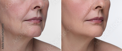 Aging skin changes. Collage with photos of mature woman before and after cosmetic procedure on white background, closeup