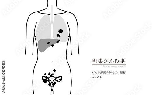 卵巣がんIV期の図解イラスト、子宮・卵巣の解剖図