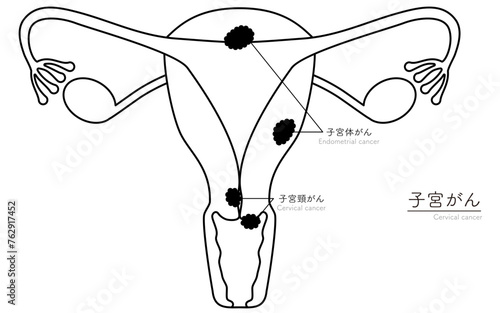 子宮がんの図解イラスト、子宮・卵巣の解剖図
