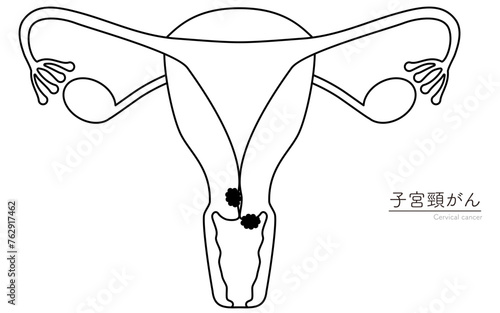 子宮頸がんの図解イラスト、子宮・卵巣の解剖図