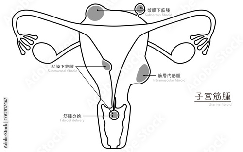 子宮筋腫の図解イラスト、子宮・卵巣の解剖図