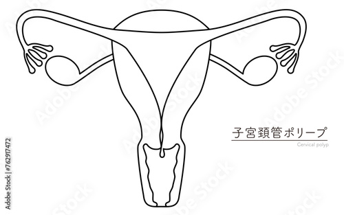 子宮頚管ポリープの図解イラスト、子宮・卵巣の解剖図