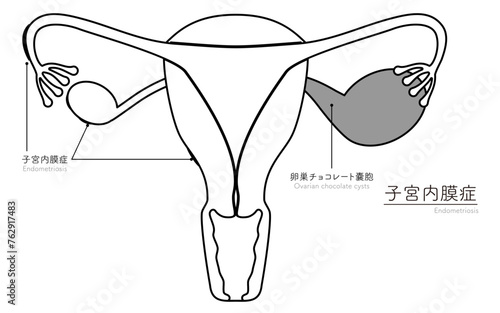 子宮内膜症の図解イラスト、子宮・卵巣の解剖図