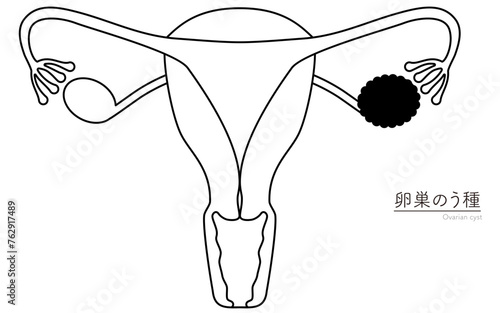 卵巣のう種の図解イラスト、子宮・卵巣の解剖図