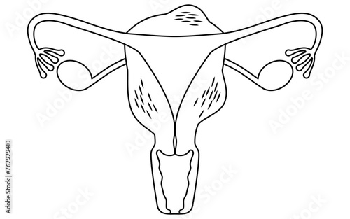 Diagrammatic illustration of adenomyosis, anatomy of the uterus and ovaries