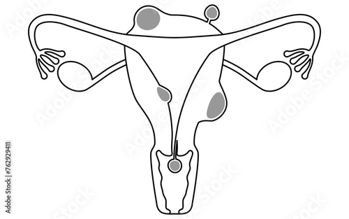 Diagrammatic illustration of uterine fibroids, anatomy of the uterus and ovaries