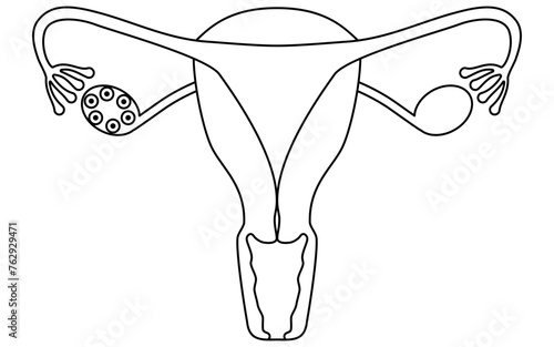 Diagrammatic illustration of polycystic ovary syndrome (ovulation disorder), anatomy of the uterus and ovaries