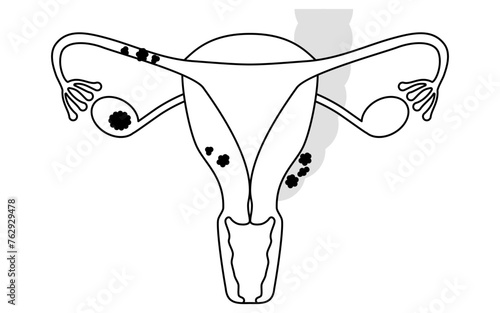 Diagrammatic illustration of stage II ovarian cancer, anatomy of the uterus and ovaries