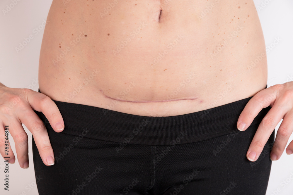 Naklejka premium young woman in underwear shows a scar from a cesarean section on a white background. concept for medicine and cosmetology.